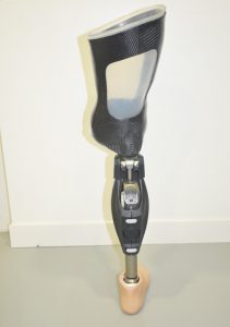 amputation au dessus de l’articulation du genou